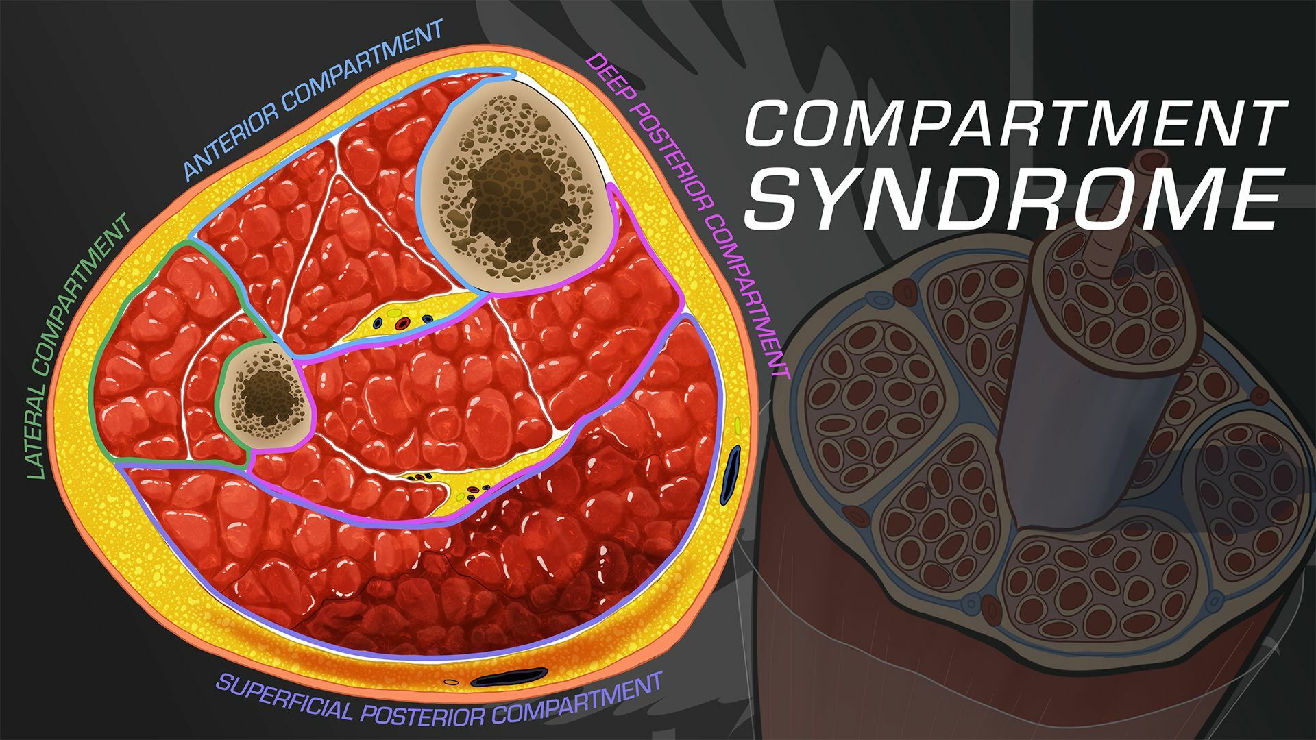 Learn About Compartment Syndrome and How To Treat It