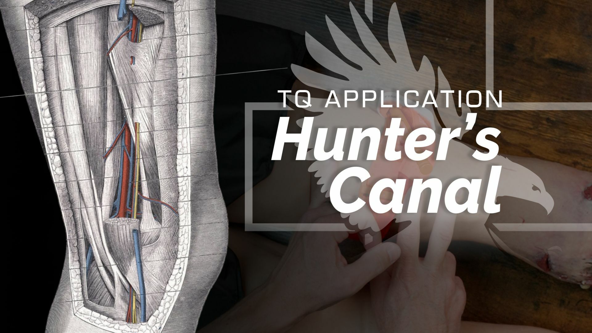 Hunter's Canal & Tourniquet Application