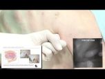 Simple Thoracostomy Kit Training Video