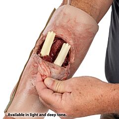 SMRT Task Trainer - Forearm Fracture